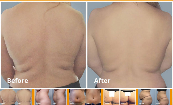 Before and after back photos showing body contouring results from a Body FX treatment