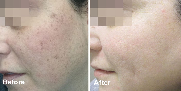 Side-by-side before and after close-up of skin showing reduced dark spots and texture